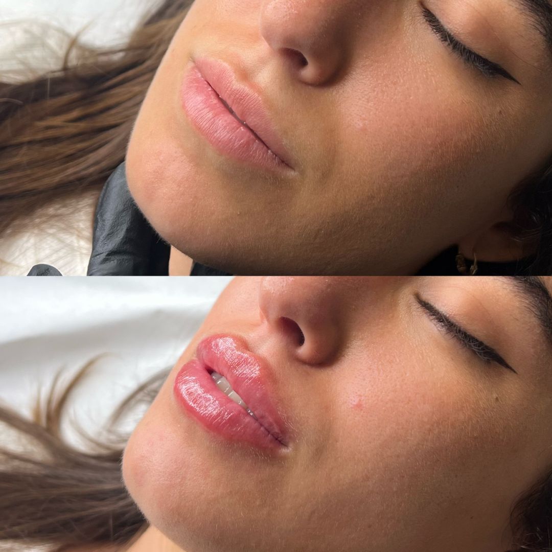 aumento de labios estefania fernandez