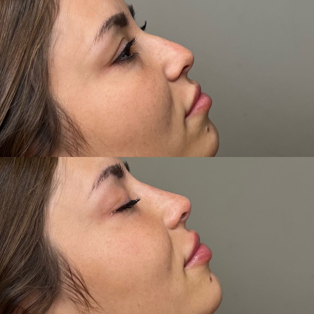 rinomodelacion estefania fernandez